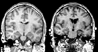 Coronal MR scans from a chronic schizophrenic (right) and normal comparison subject (left). Note increase in CSF in left amygdala-hippocampal complex.