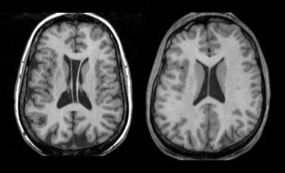 Axial MRI scans from two VCFS subjects, the one on the left showing cavum septi pellucidi and the one on the right pronounced brain asymmetry.